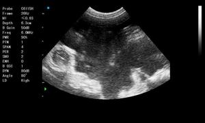 Ascites ultrasound s